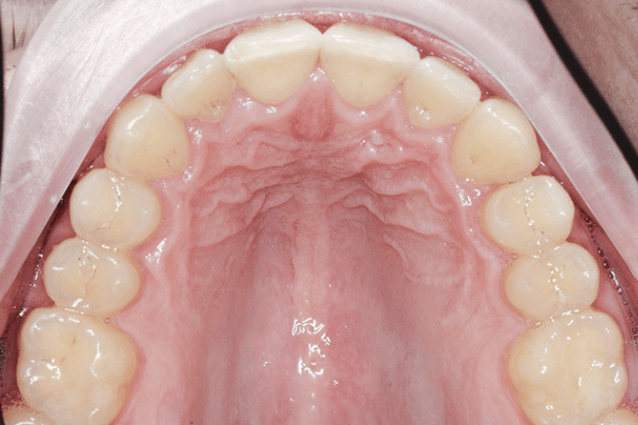 Исправление глубокого резцового перекрытия и ретрузии верхней челюсти элайнерами
