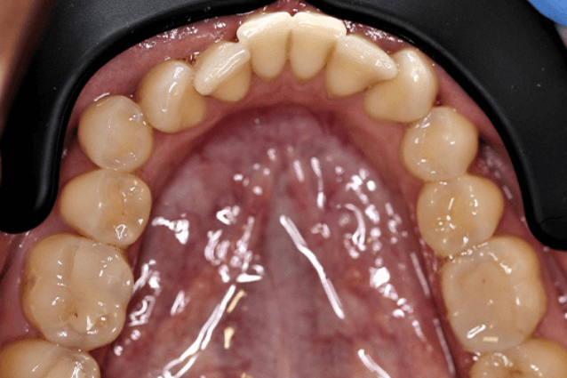 Исправление прикуса элайнерами за 2 месяца